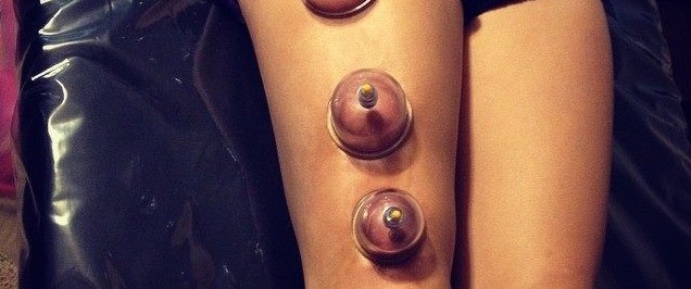 Cupping for Knee Pain